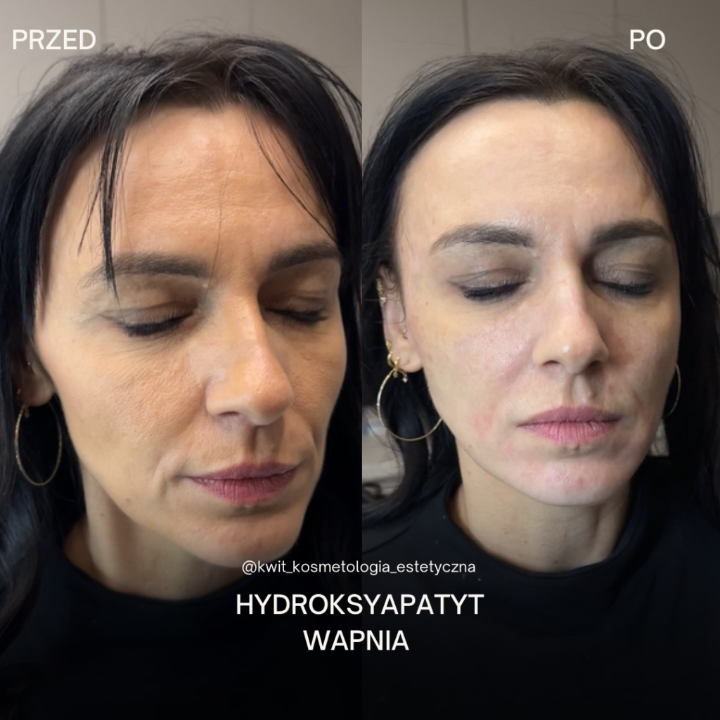Efekt przed i po zabiegu Hydroksyapatyt wapnia - stymulatory tkankowe lublin kwit kosmetologia