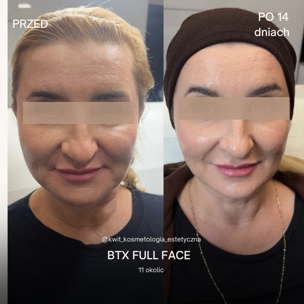 Efekt zabiegu Full Face BTX Effect Lublin - 11 okolic