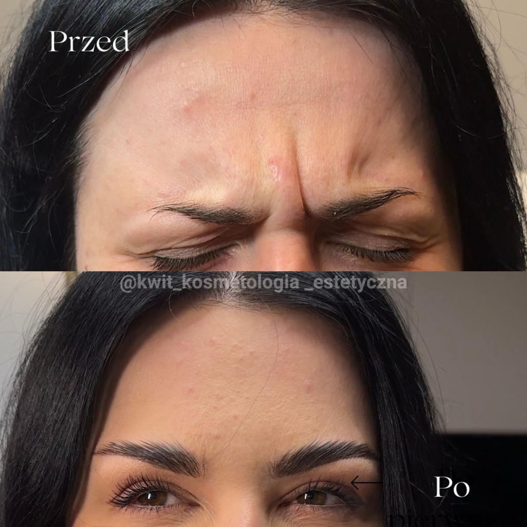 Efekt zabiegu BTX Effect Lublin - przedstawione zdjęcia czoła przed i po