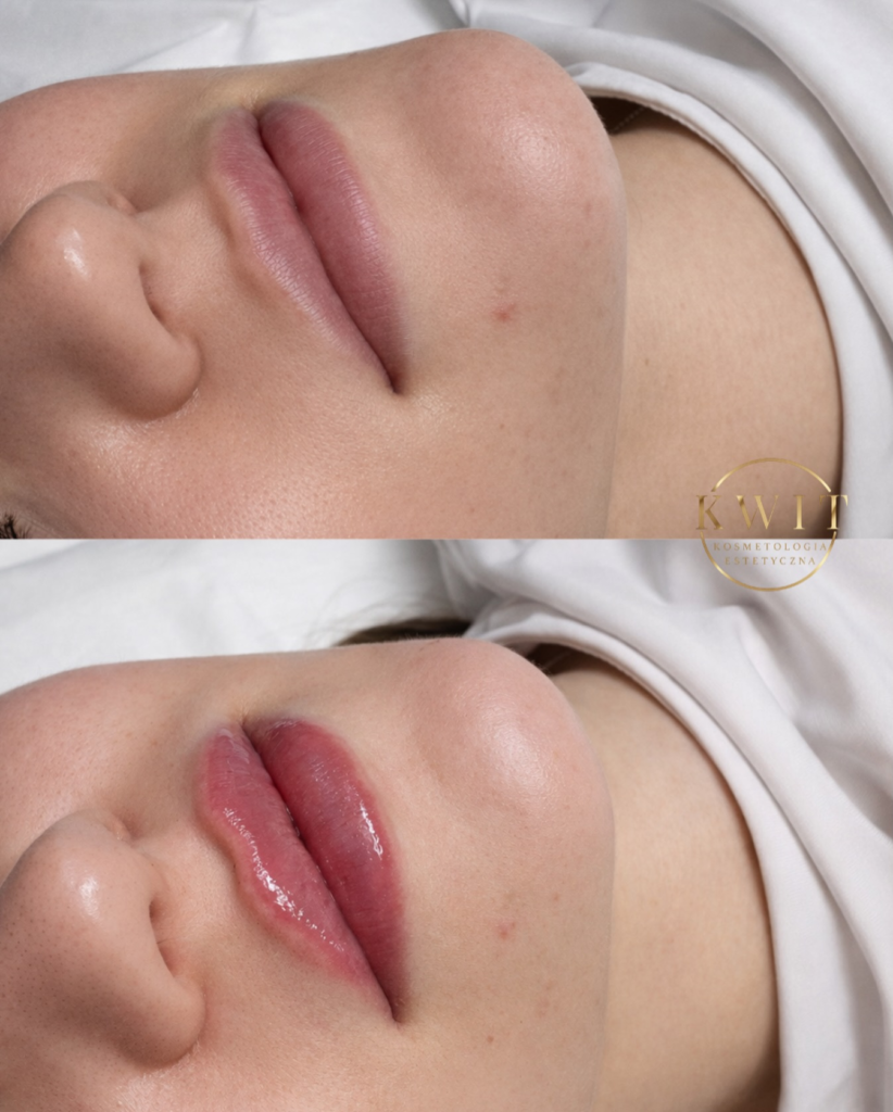 Modelowanie ust efekt przed i po - Modelowanie twarzy Lublin